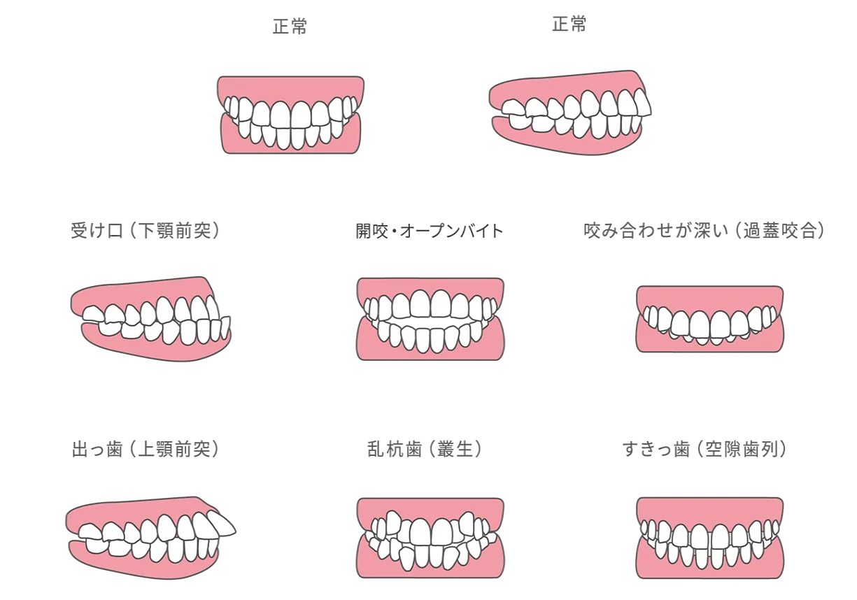 不正咬合の種類