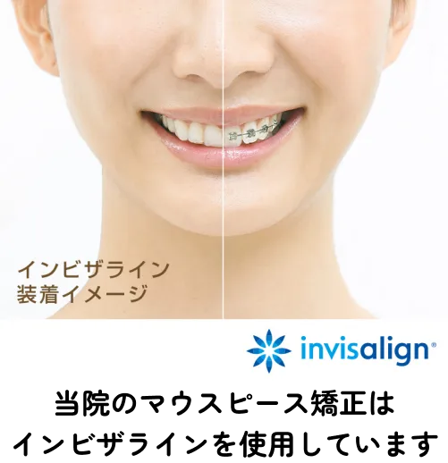 インビザライン装着イメージ