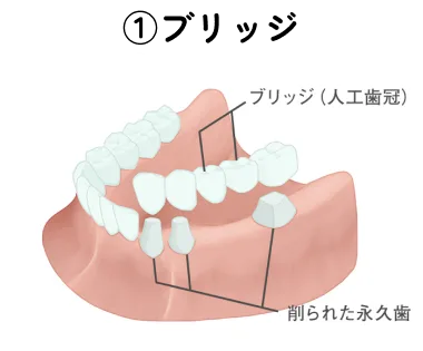 ブリッジ