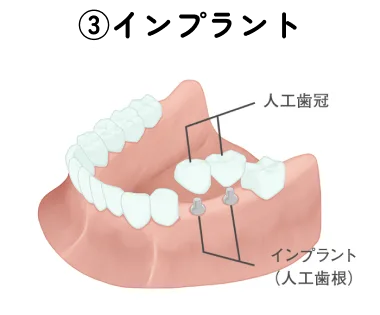 インプラント